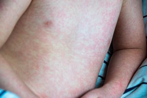 Viral disease. Measles rash on the body of the child. Allergy 112180100000042571.jpg