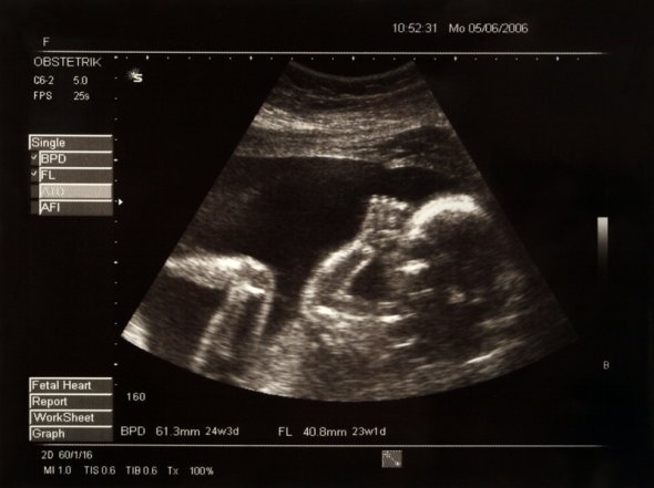 Ultraschallbild einer schwangeren Frau